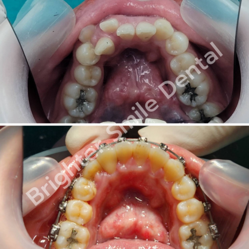 จัดฟัน Damon