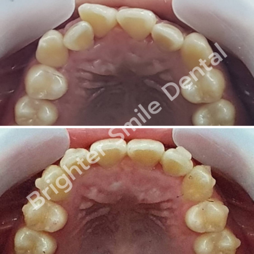 จัดฟันใส