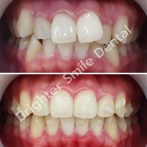 จัดฟันใส