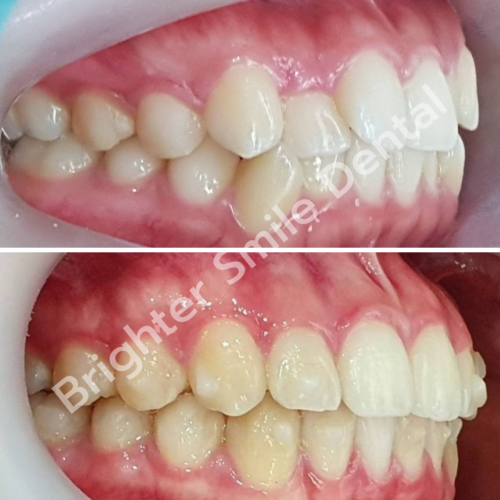 จัดฟันใส