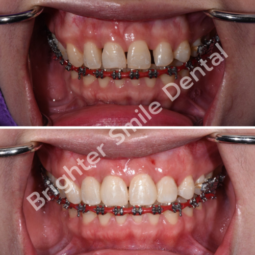 ปิดช่องฟันห่าง