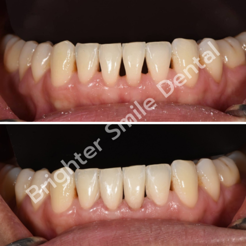 อุดปิดช่องฟันห่าง